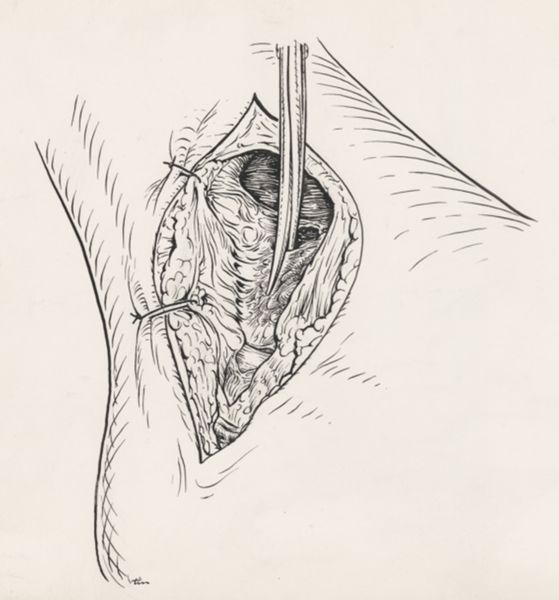J Tinkelenberg, Surgery of the ankle ligament