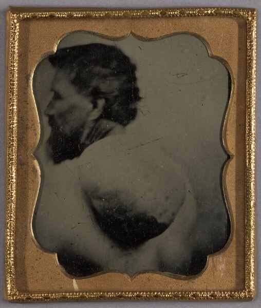 Unknown, [Portrait of a Bearded Man with Abnormal Hump Growth on Back]