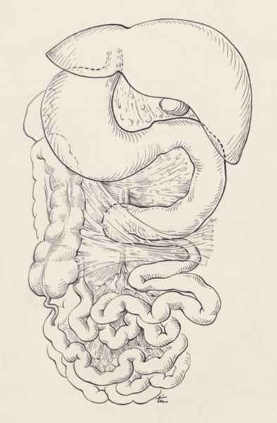 J Tinkelenberg, Inversion of the intestines