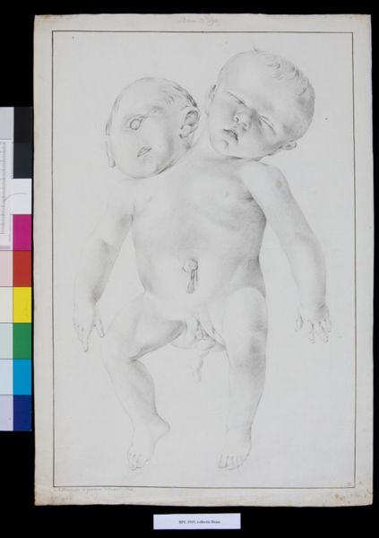 M. Houtman, Conjoined twins