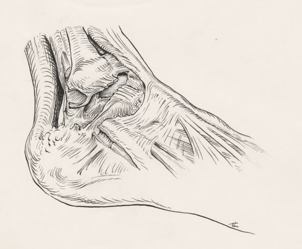 J Tinkelenberg, Torn ankle ligament
