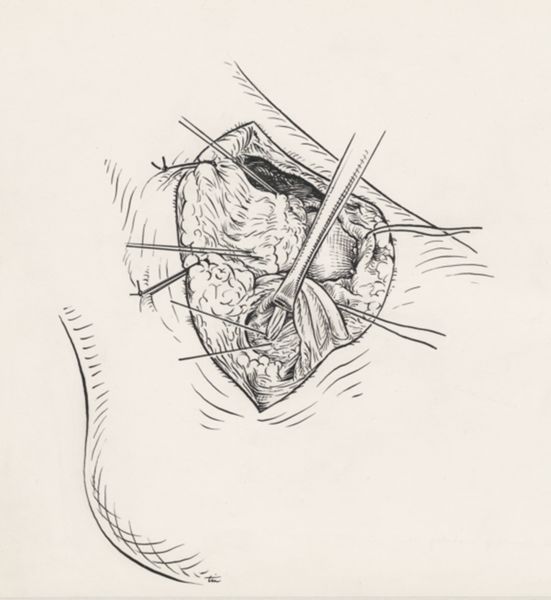 J Tinkelenberg, Surgery of the ankle ligament