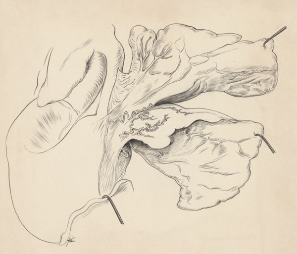 J Tinkelenberg, Part of the heart and circulatory system