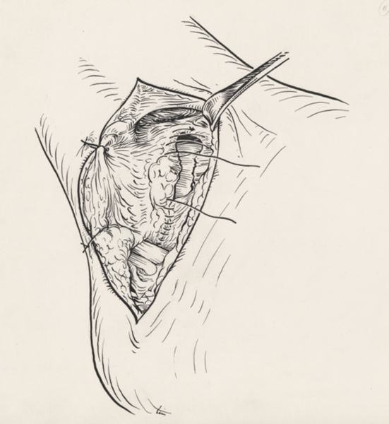 J Tinkelenberg, Surgery of the ankle ligament