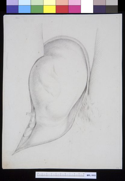 M Houtman, Inguinal hernia
