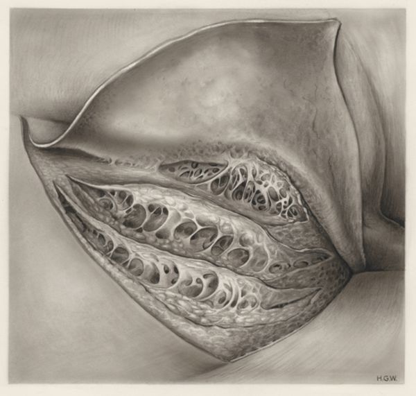 H.G Wetselaar, Tissue of the buttocks