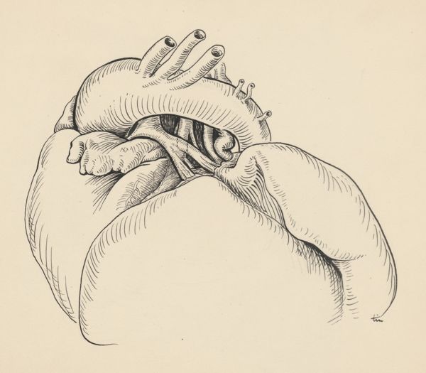 J Tinkelenberg, Heart