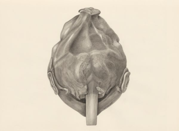 H.G Wetselaar, Deformed fetal head, seen from the back