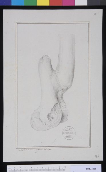 M Houtman, Pathology, fractures (Forearm)