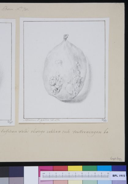 M Houtman, Gallbladder with stones
