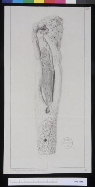 M Houtman, Pathology, fractures (Lower leg)