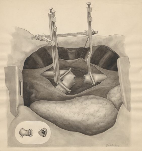 J Tinkelenberg, Part of the heart and circulatory system