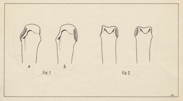 J Tinkelenberg, Schematic representation of finger joints