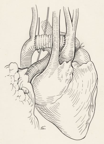 J Tinkelenberg, Aortic surgery
