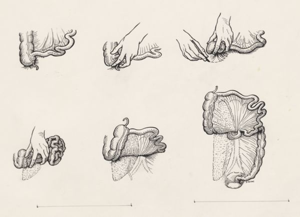 J Wetselaar-Whittaker, Procedure on intestinal tissue