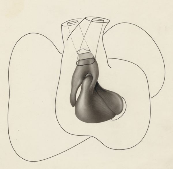 J Tinkelenberg, Embryonic heart