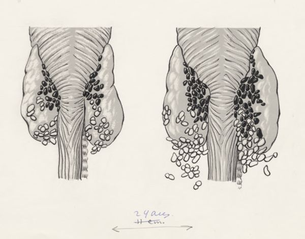 J Tinkelenberg, Infected tissue