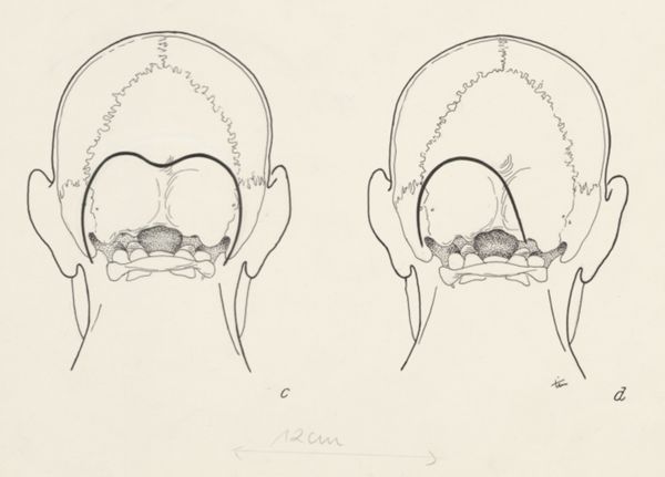 J Tinkelenberg, Neurosurgical Procedures