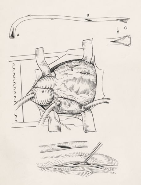 J Tinkelenberg, Thorax surgery