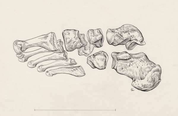 J Tinkelenberg, Eleven bones of the foot
