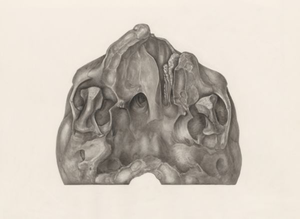 H.G Wetselaar, Deformed jawbone