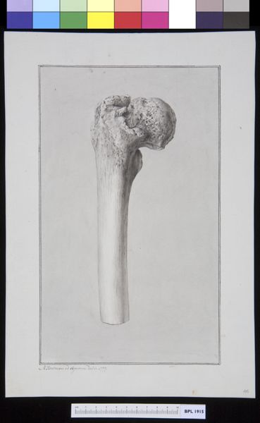 M. Houtman, Infected bone (femur)