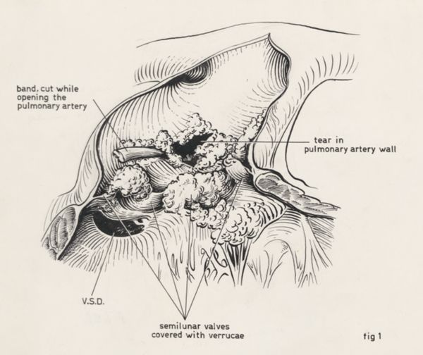 J Tinkelenberg, Embryonic heart