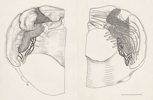 J Tinkelenberg, Reconstruction of the cerebellum
