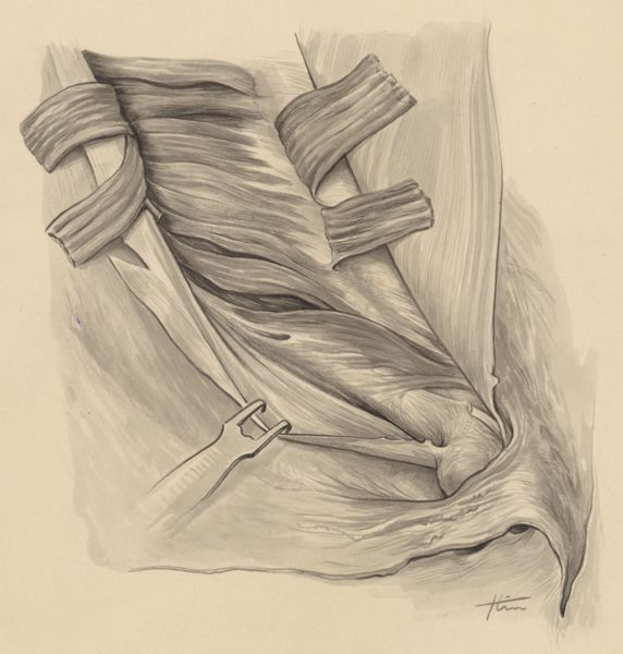 J Tinkelenberg, Tissue of the inguinal