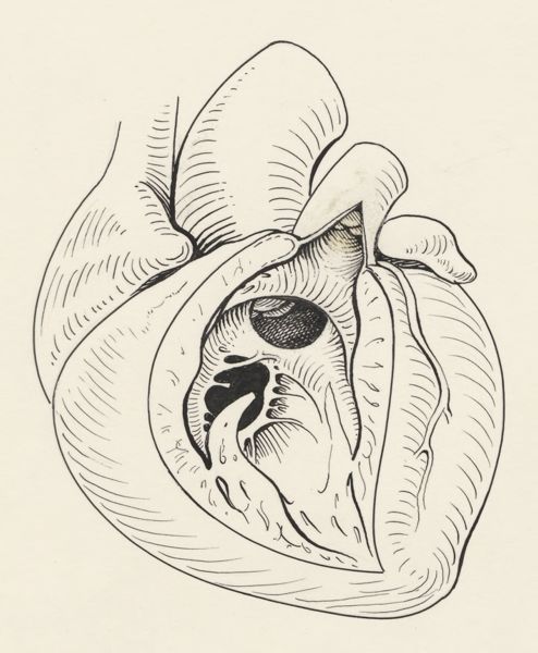J Tinkelenberg, Heart