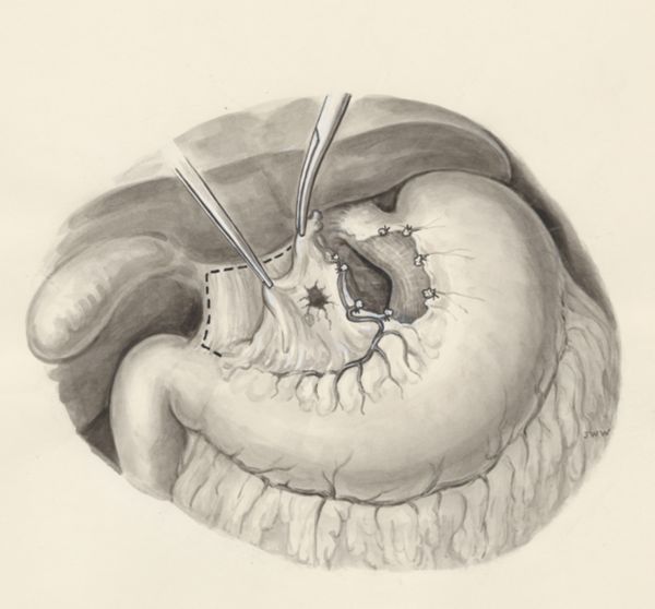J Wetselaar-Whittaker, Surgery on a part of the human body