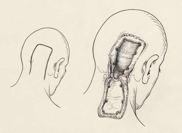 J Tinkelenberg, Neurosurgical Procedures