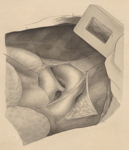 J Tinkelenberg, Thorax surgery