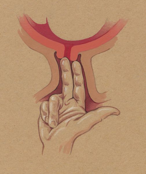 J Tinkelenberg, gynaecological procedure, two fingers penetrating the cervix