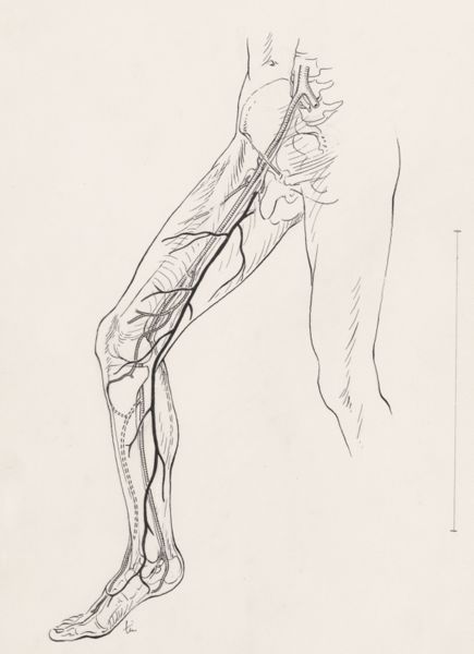 J Tinkelenberg, Tissue from the right leg and foot