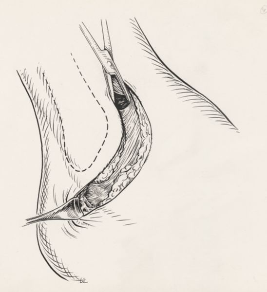 J Tinkelenberg, Surgery of the ankle ligament