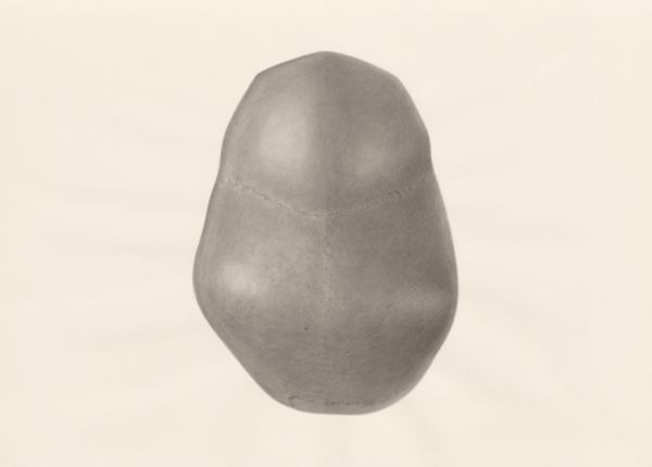 H.G Wetselaar, Deformed fetal skull, seen from above