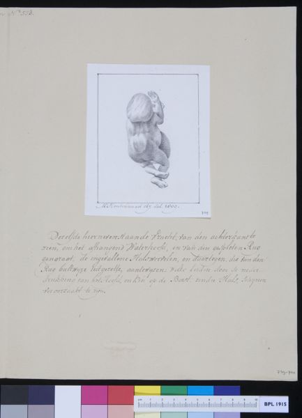 M Houtman, Deformed fetus