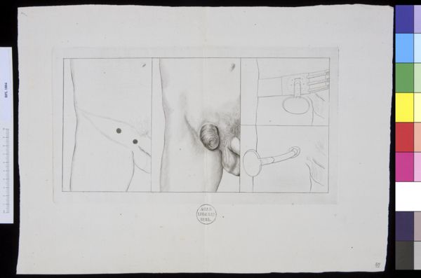 M Houtman, Pathology, fractures