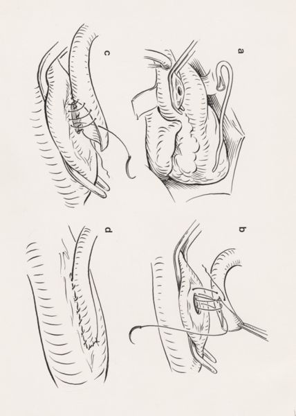 J Tinkelenberg, Thorax surgery