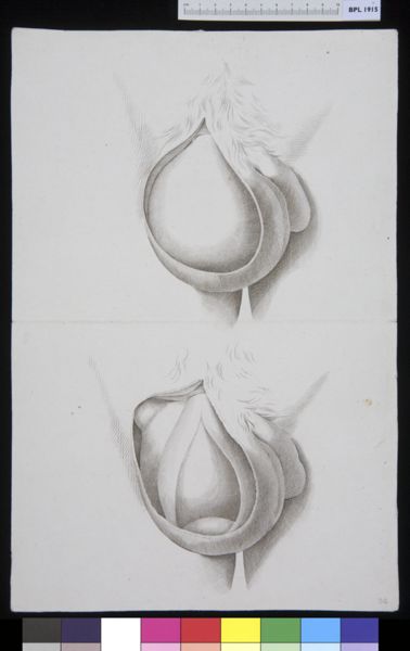 M Houtman, Scrotum, hernia