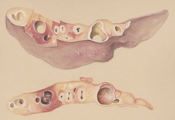 J Wetselaar-Whittaker, Lung tissue