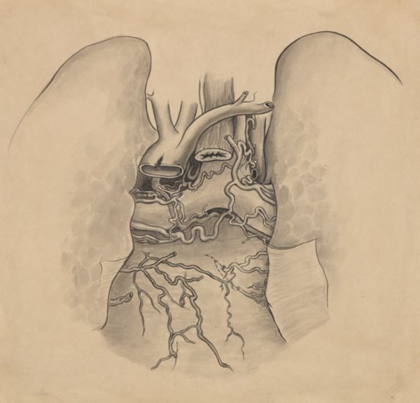 J Tinkelenberg, Heart and adjacent organs