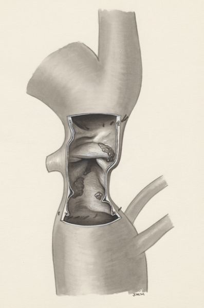 J Wetselaar-Whittaker, Heart surgery