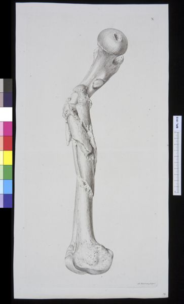 M Houtman, Infected bone (femur?)