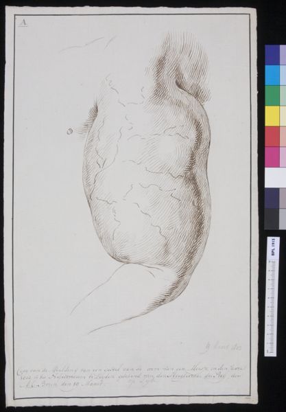 A Bonn, Swelling of a girl's arm