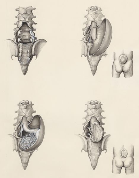 J Wetselaar-Whittaker, Protrusion of the lower back