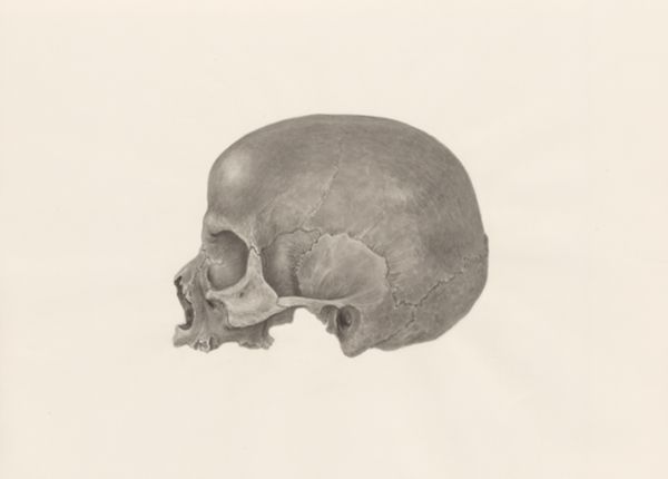 H.G Wetselaar, Deformed fetal skull