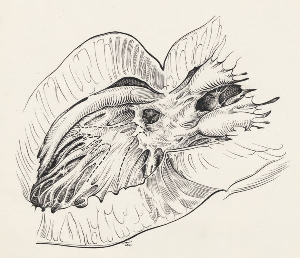 J Tinkelenberg, Thorax surgery