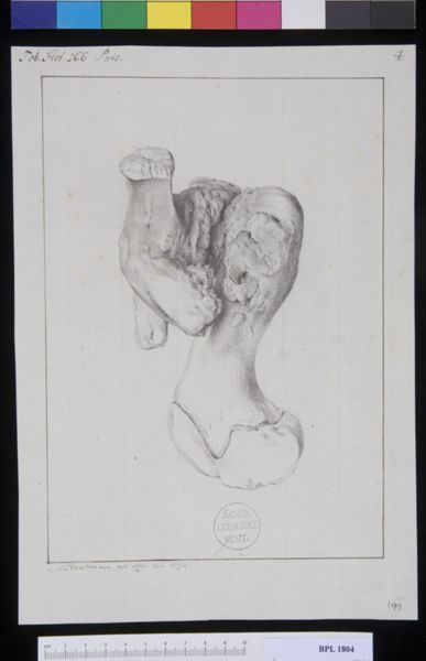 M Houtman, Pathology, fractures (Femur)